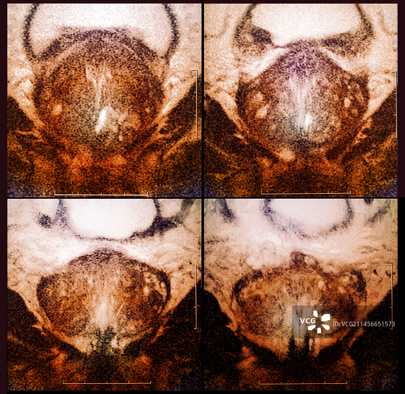 前列腺癌核磁共振扫描图片素材