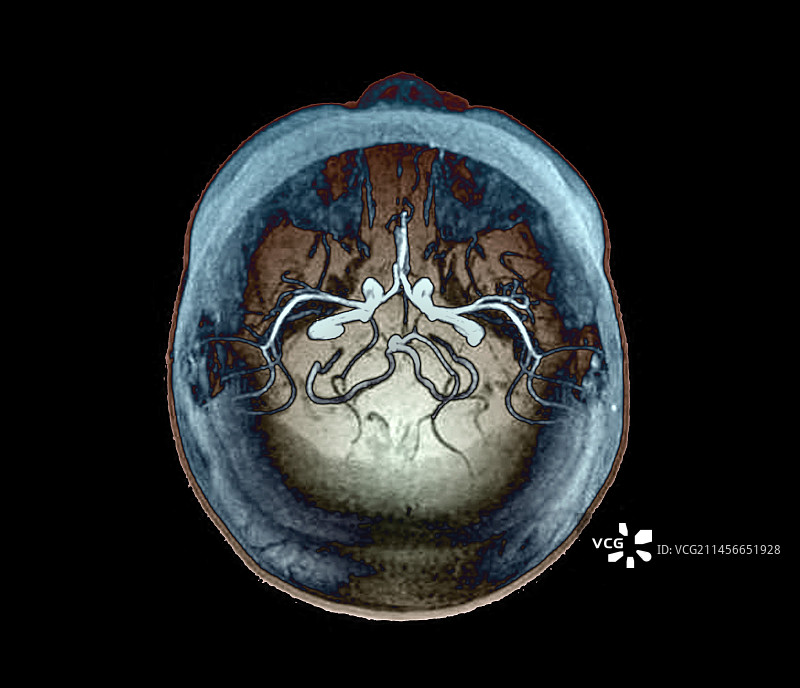 癫痫核磁共振血管造影图片素材