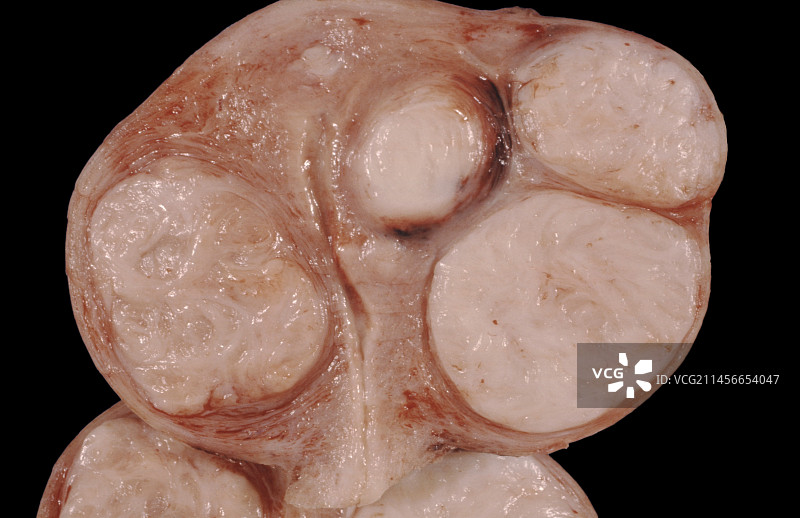 子宫肌瘤图片素材