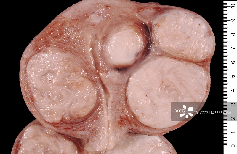 子宫肌瘤图片素材