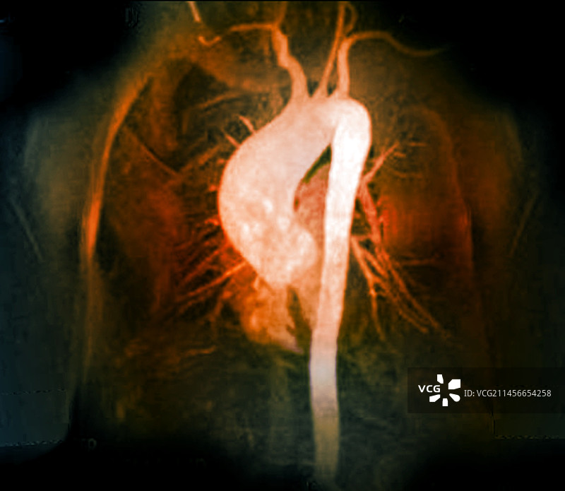 主动脉动脉瘤MRA图片素材