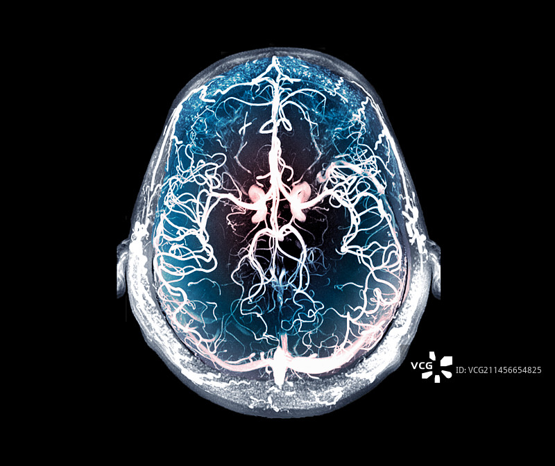 大脑血管核磁共振血管造影图片素材