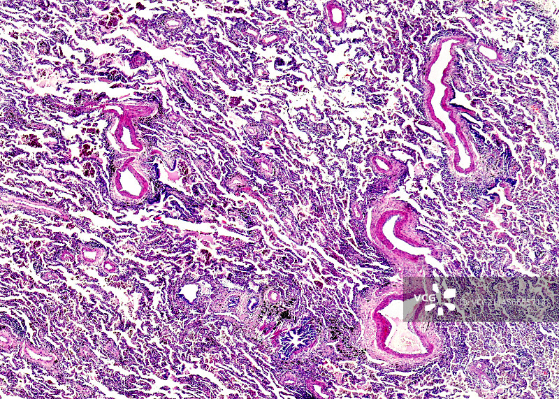 肺水肿显微照片图片素材