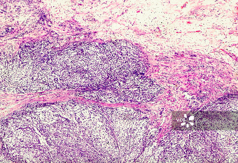 性腺外生殖细胞肿瘤显微照片图片素材