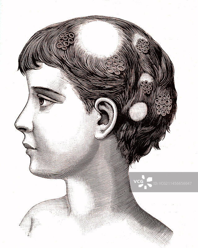 19世纪癣病插画图片素材