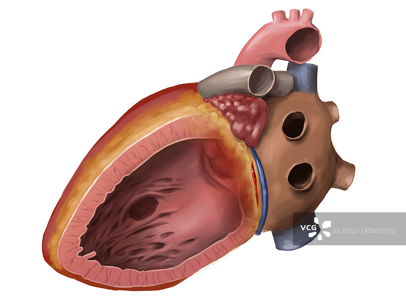 室间隔缺损图示图片素材