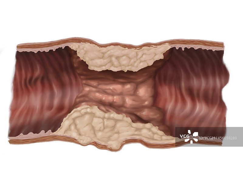 结肠浸润性腺癌插图图片素材