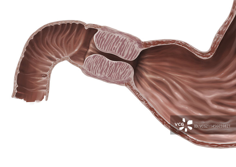 幽门狭窄示意图图片素材