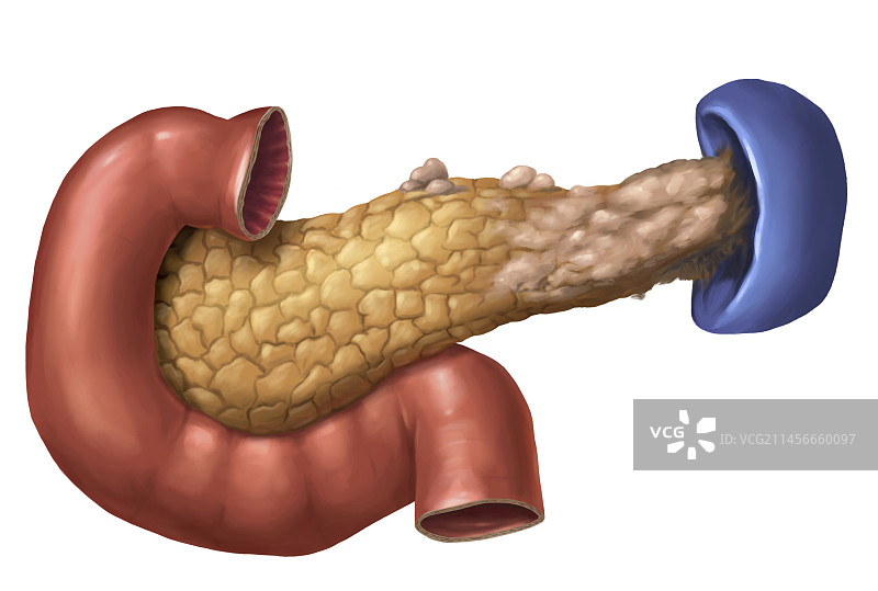 胰腺癌插图图片素材