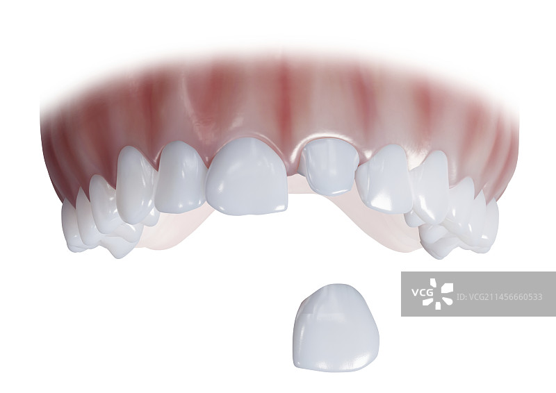 牙冠插图图片素材