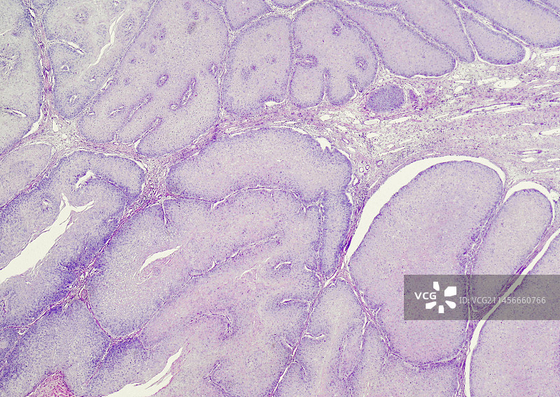 阴茎包皮尖锐湿疣显微照片图片素材