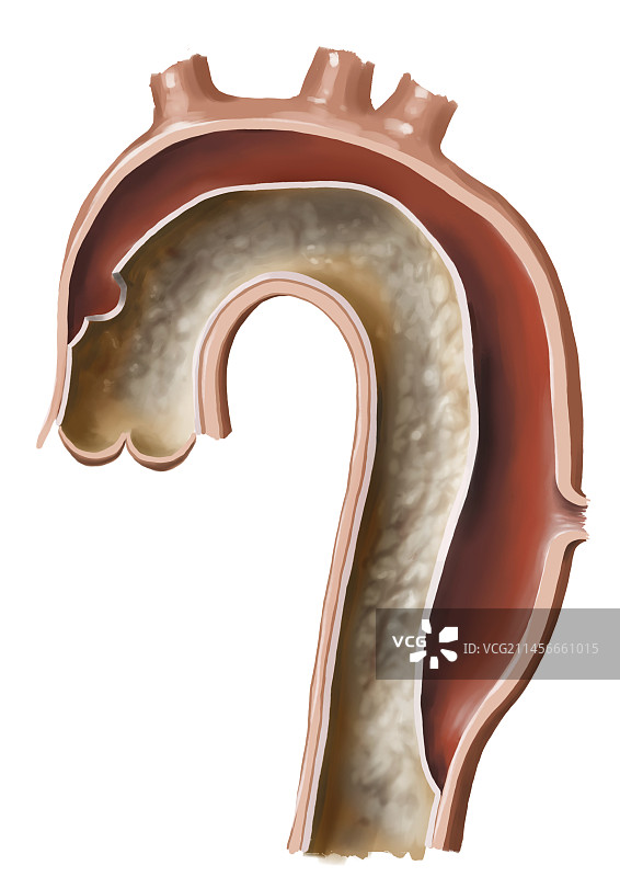 主动脉夹层图示图片素材