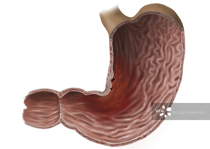 晚期胃癌，图示图片素材