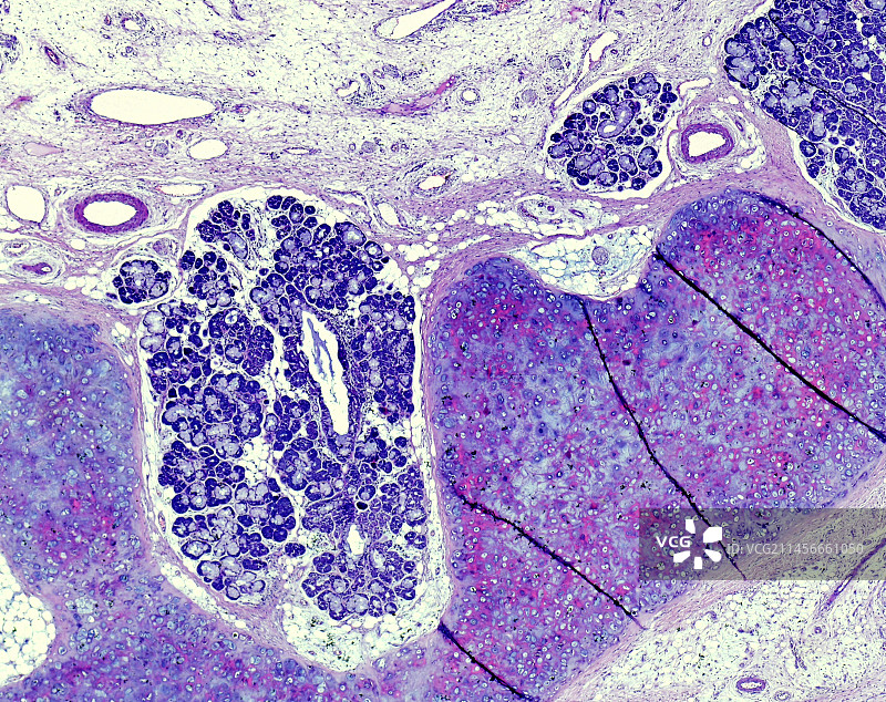喉癌，光学显微照片图片素材
