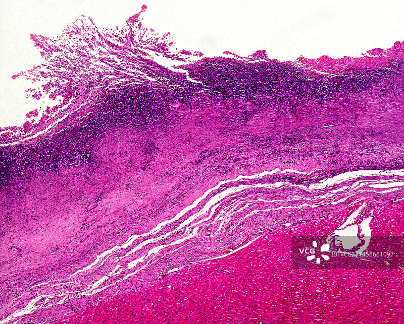 心肌病，光学显微照片图片素材