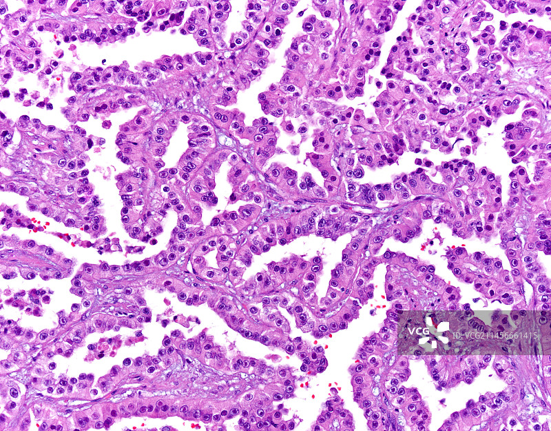 肾乳头状细胞癌，光学显微镜照片图片素材