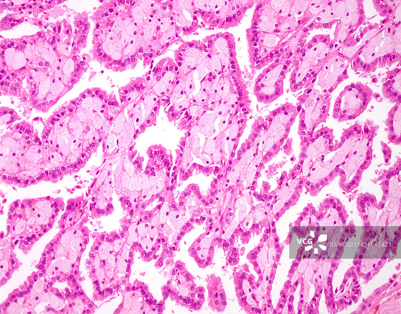 肾乳头状细胞癌，光学显微镜照片图片素材