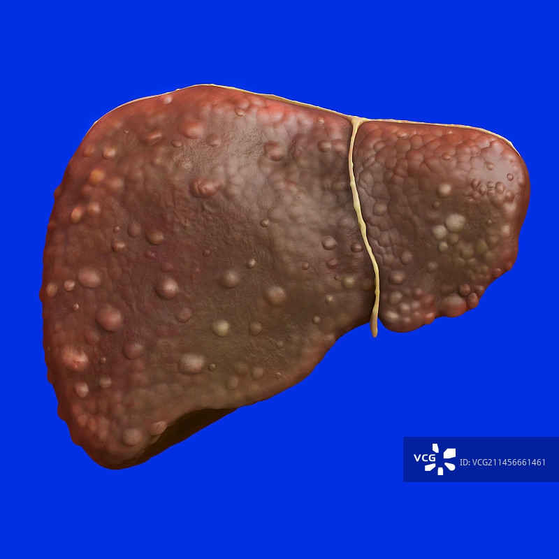 肝硬化疾病医学插图图片素材