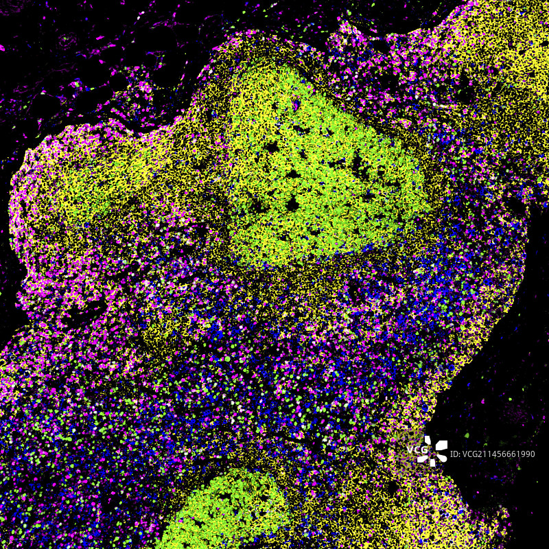 艾滋病毒感染者的淋巴结荧光显微照片图片素材