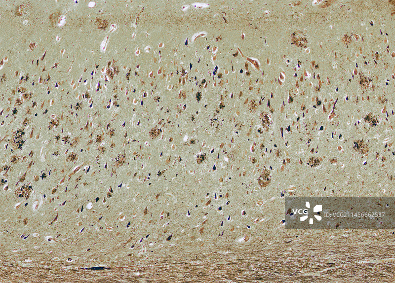 阿尔茨海默病显微照片图片素材