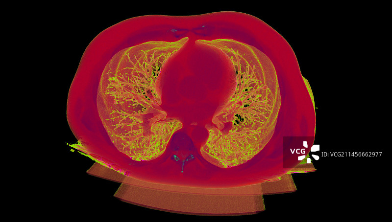 健康的心脏和肺部3D CT扫描图片素材