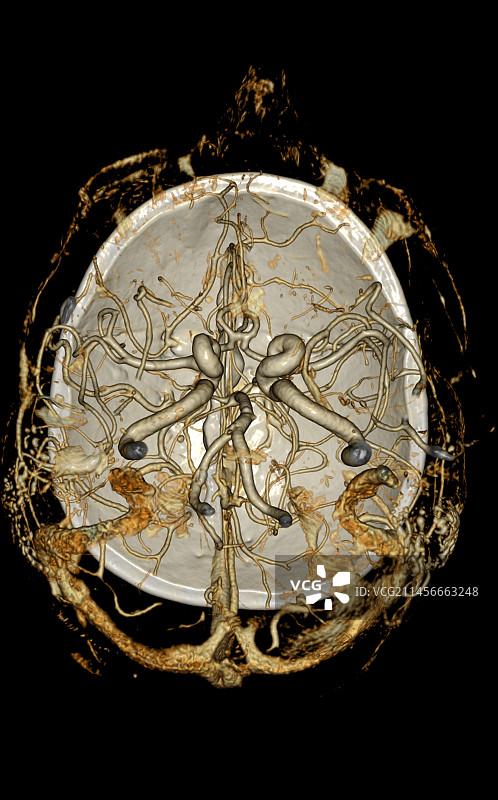 大脑血管3D CT扫描图片素材