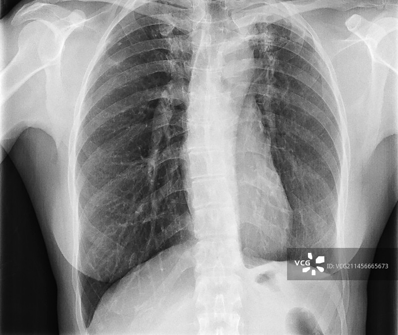 结核病疤痕X光片图片素材