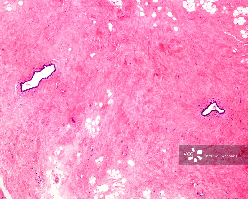 乳腺纤维化显微照片图片素材