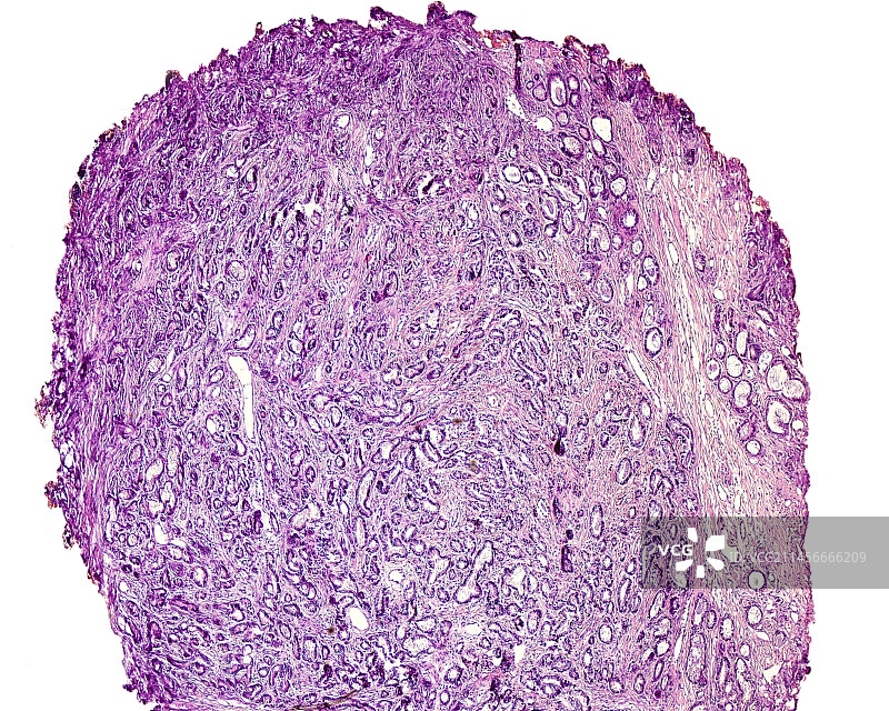 前列腺腺癌显微照片图片素材