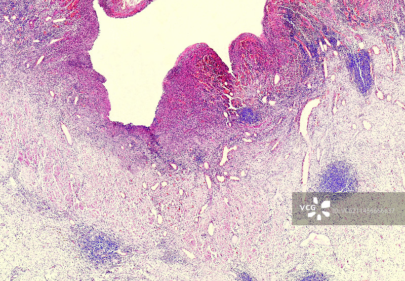 假膜性结肠炎显微照片图片素材