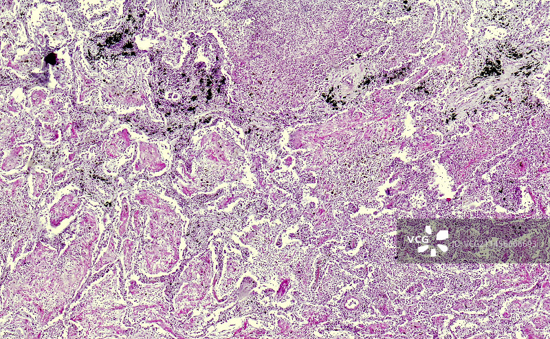 石棉肺，光学显微照片图片素材
