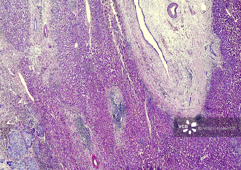 肝内胆管癌图片素材