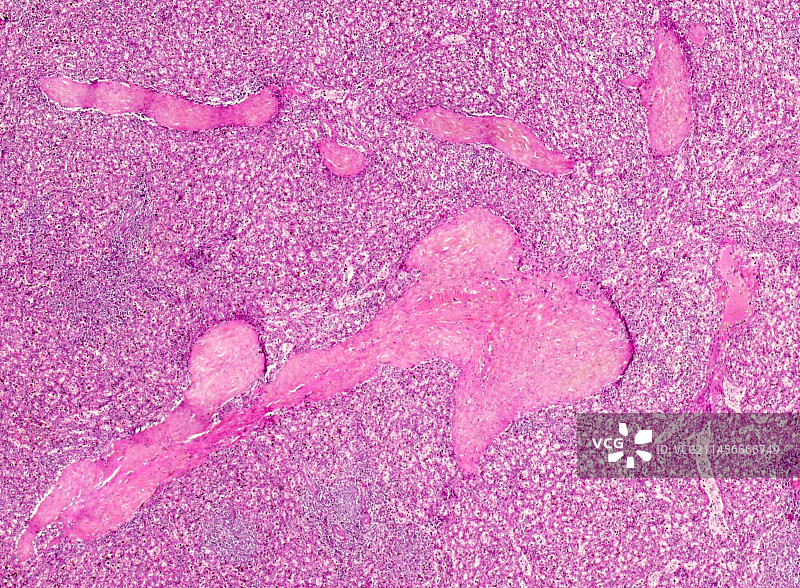 脾动脉玻璃样变性显微照片图片素材