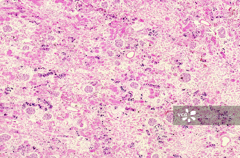 人体肾脏中的氯化汞，光学显微照片图片素材