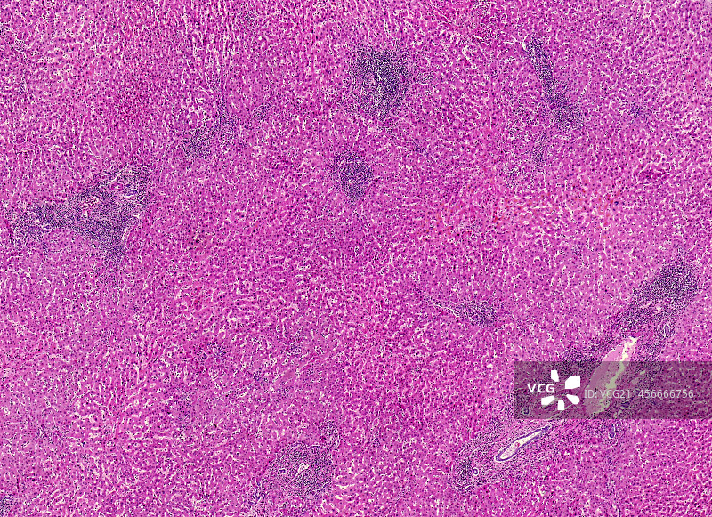 肉瘤样癌，光学显微照片图片素材