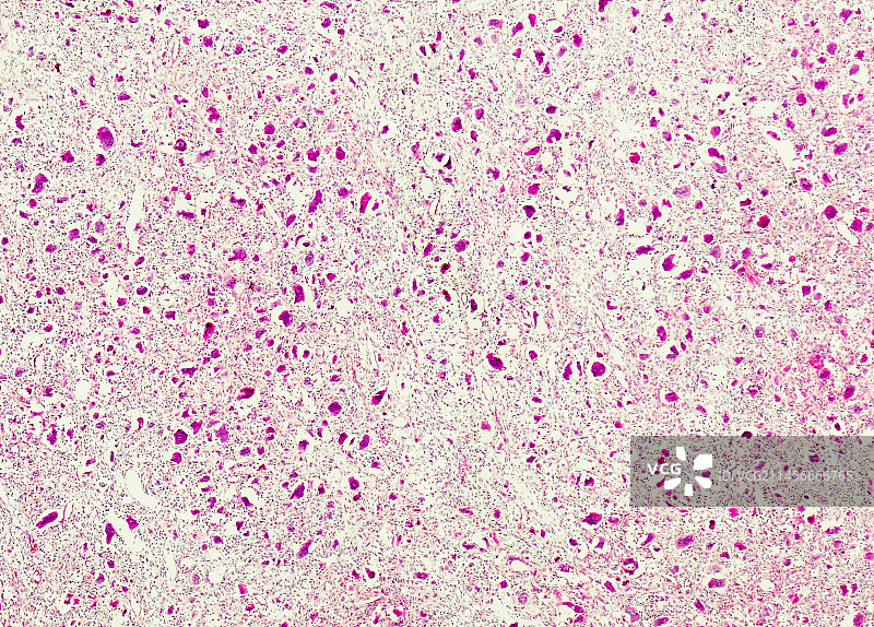 颌骨多发性骨髓瘤，光学显微镜照片图片素材