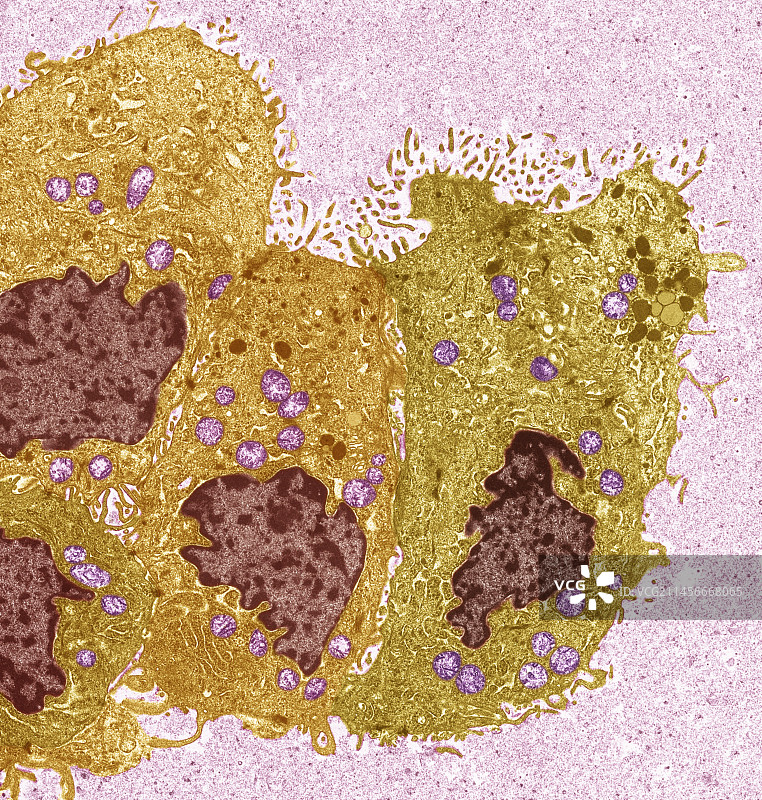 乳腺癌，TEM图片素材