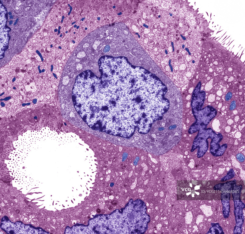 胃癌，TEM图片素材