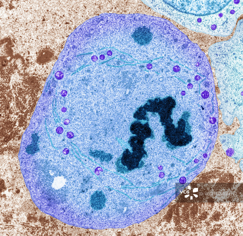 睾丸癌，TEM图片素材