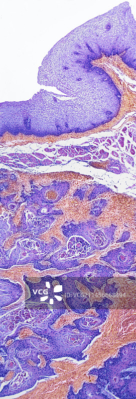 外阴鳞状细胞癌，LM图片素材