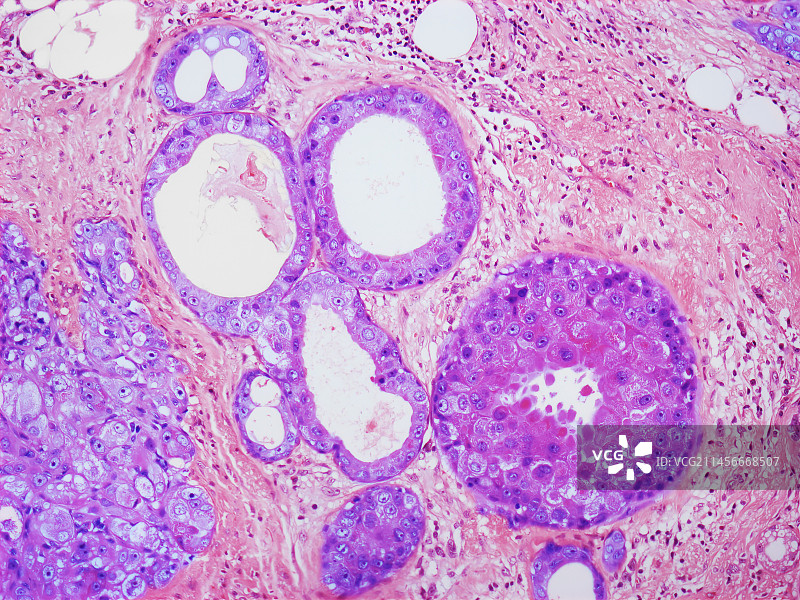 乳腺癌图片素材