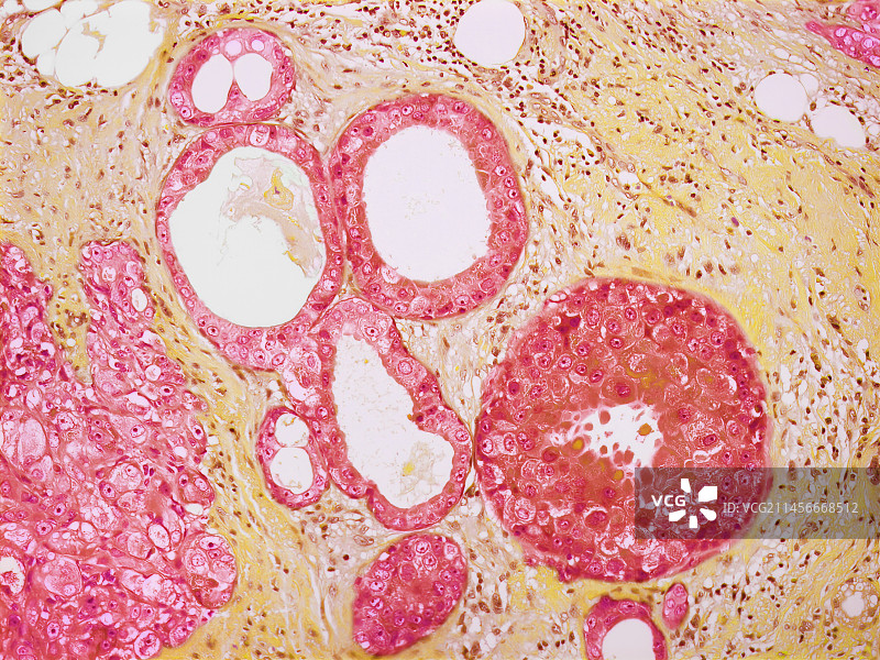 乳腺癌图片素材