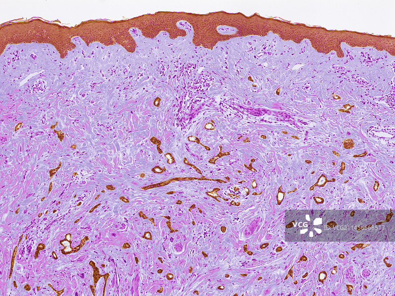 乳腺癌图片素材