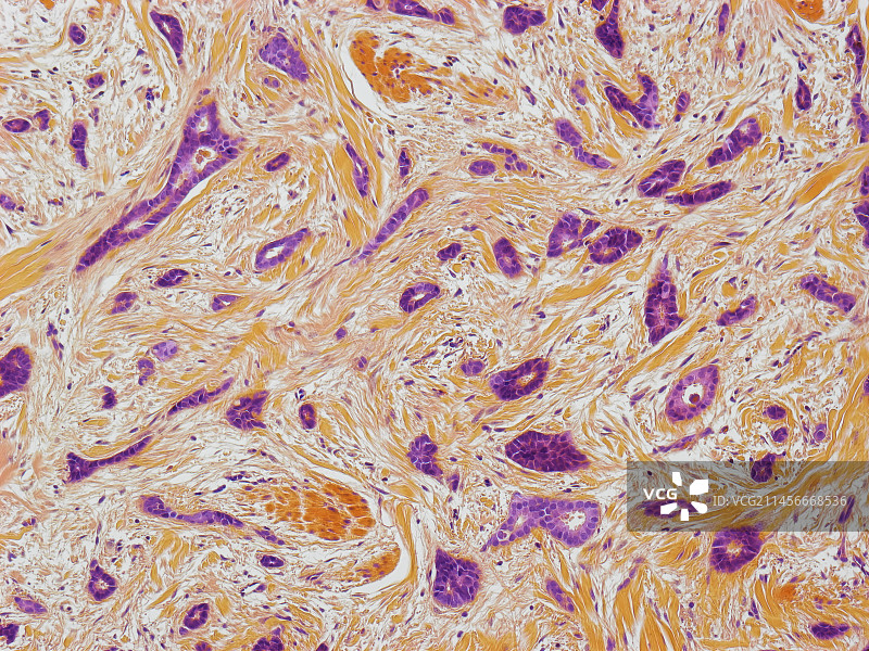 乳腺癌图片素材