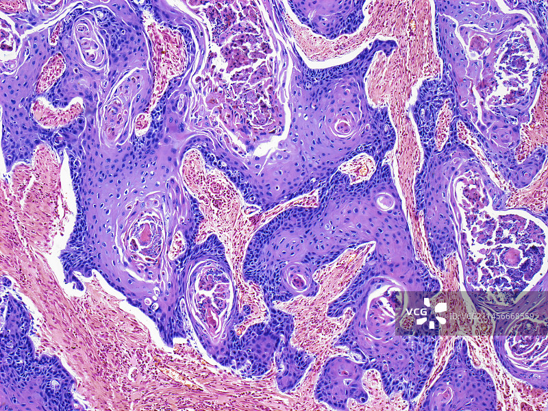 外阴鳞状细胞癌，LM图片素材