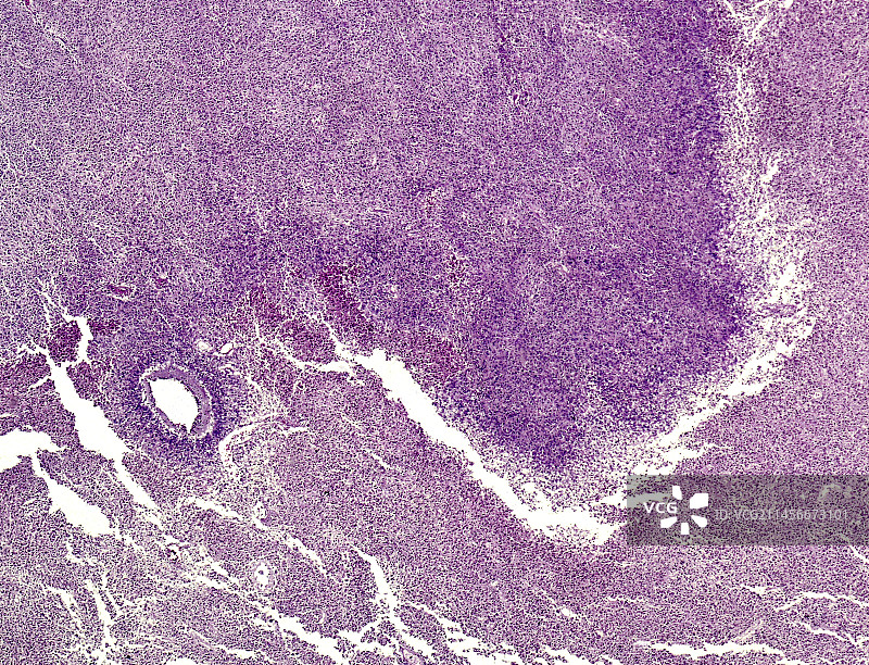 神经星形细胞瘤，显微照片图片素材