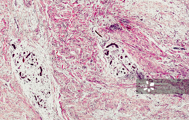 神经纤维瘤显微照片图片素材