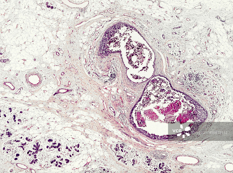 乳腺硬癌图片素材
