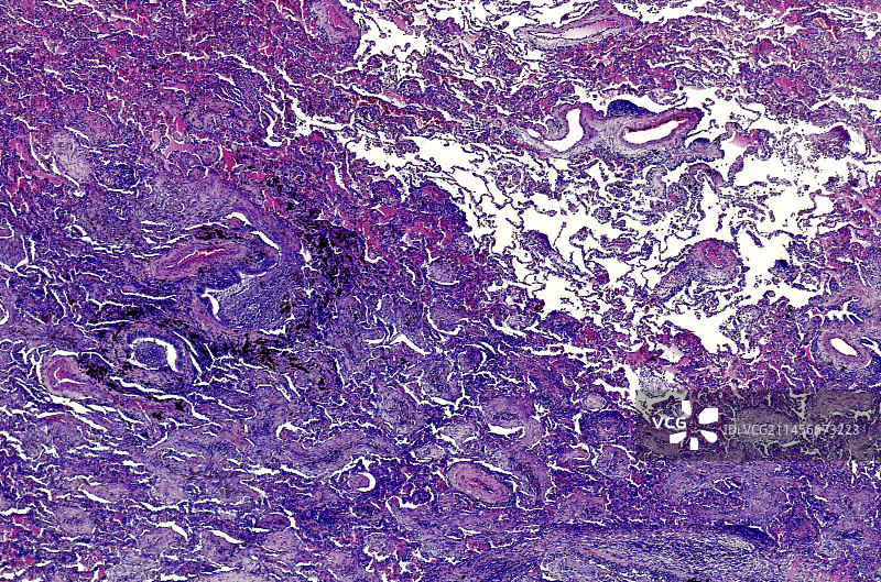 囊性纤维化，光学显微照片图片素材