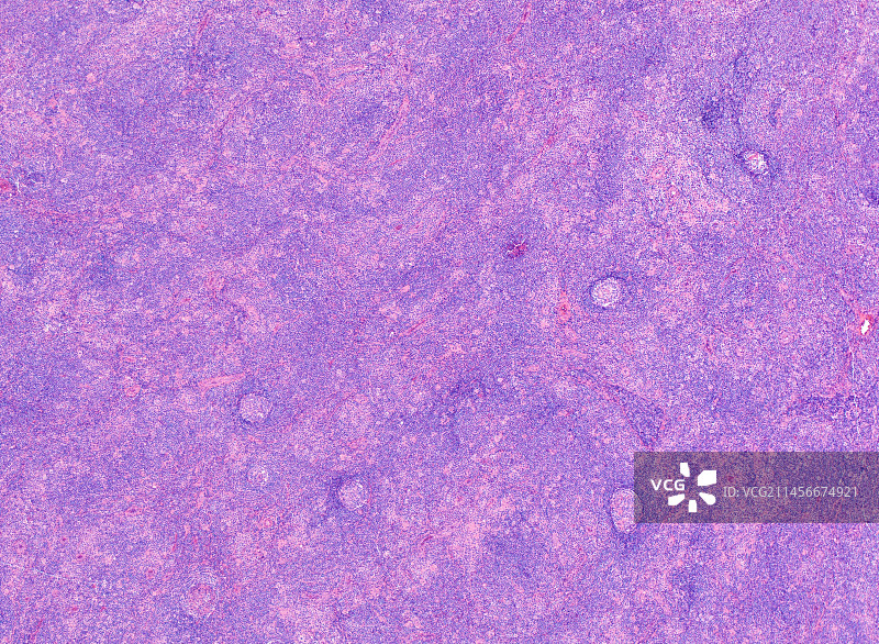 结节性淋巴细胞为主型霍奇金淋巴瘤显微照片图片素材